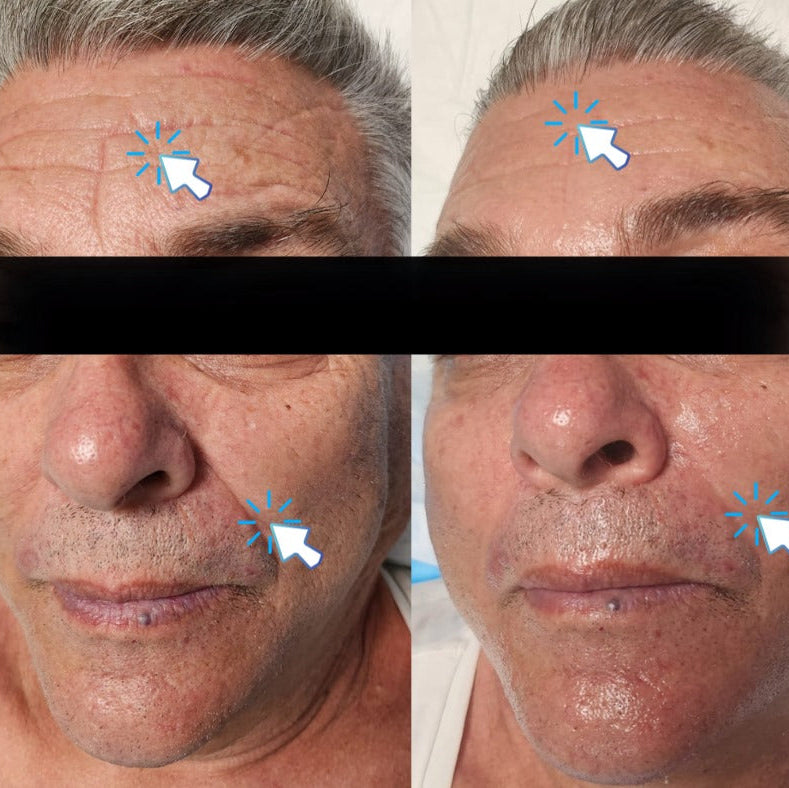 Terapia Facial OXY TOX