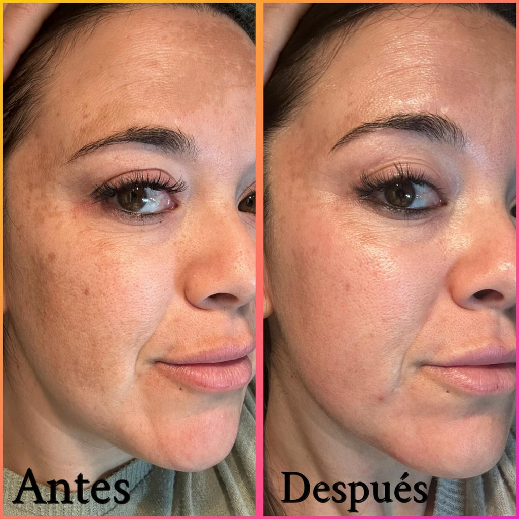 Tratamiento Anti-Manchas
