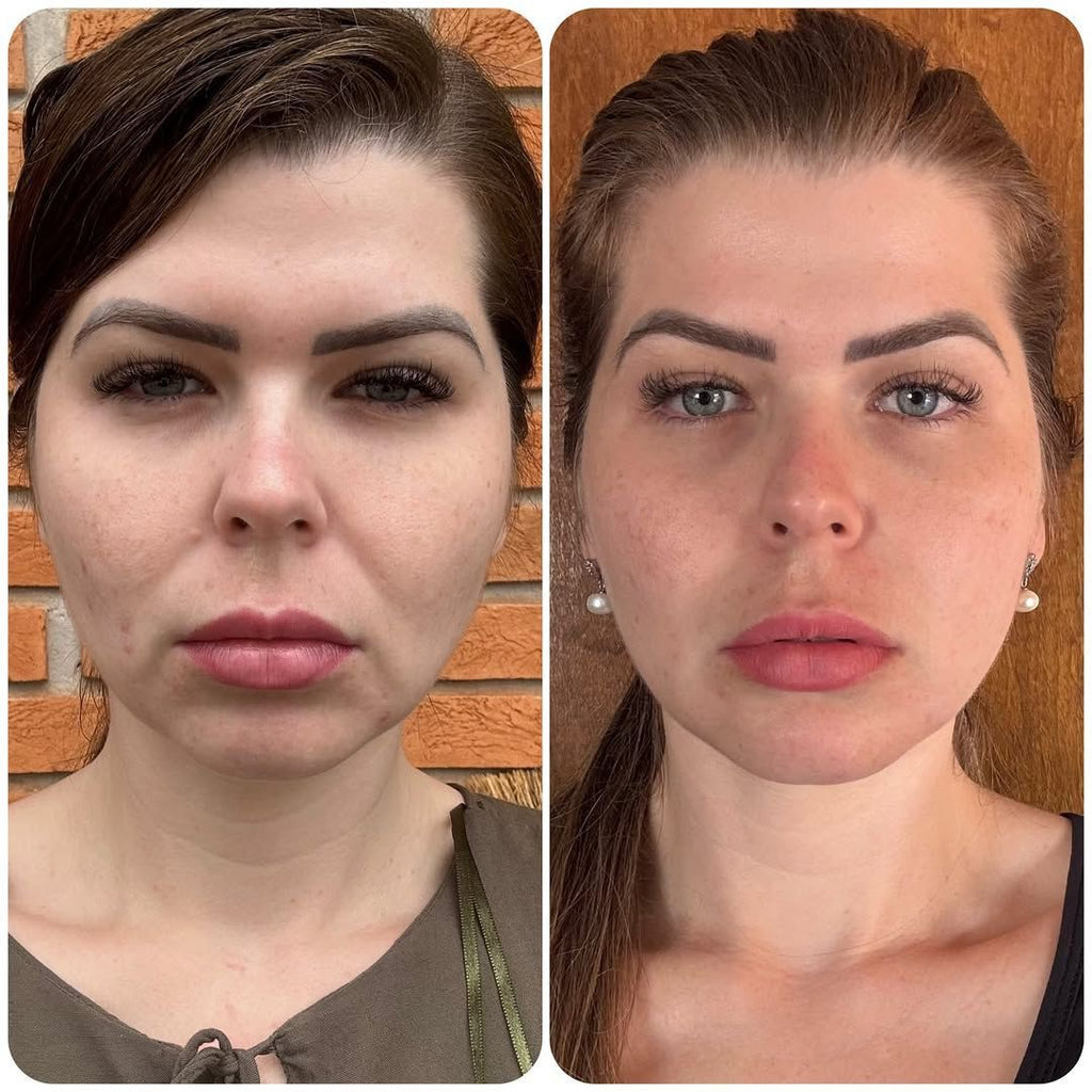 Rejuvenecimiento facial con Dust Galaxy – Bioestimulador con ácido poliláctico