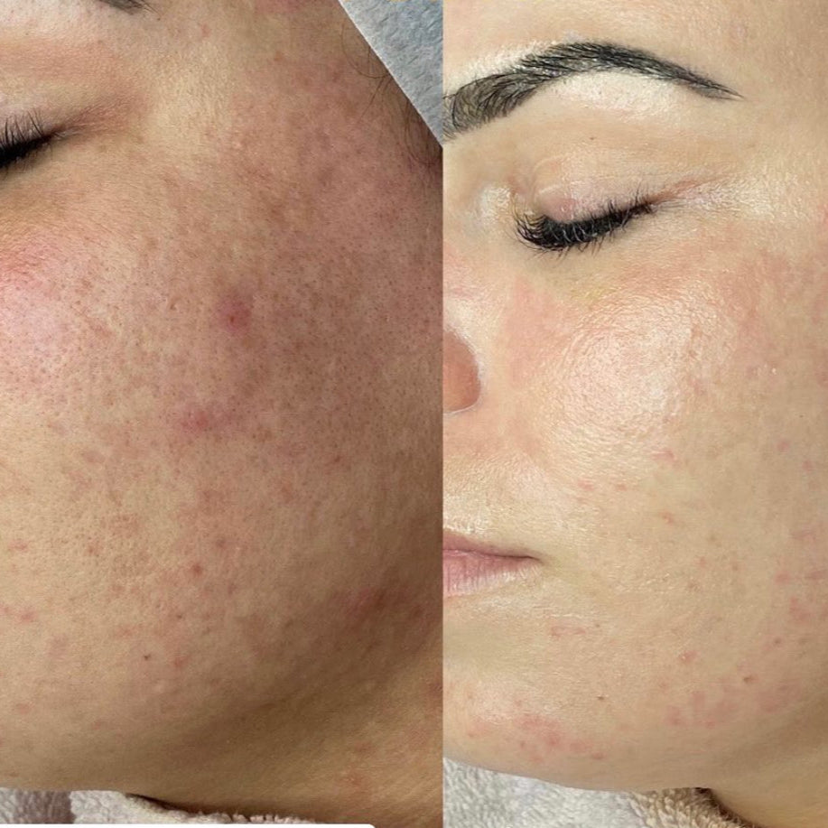 Perfect Tone Glow