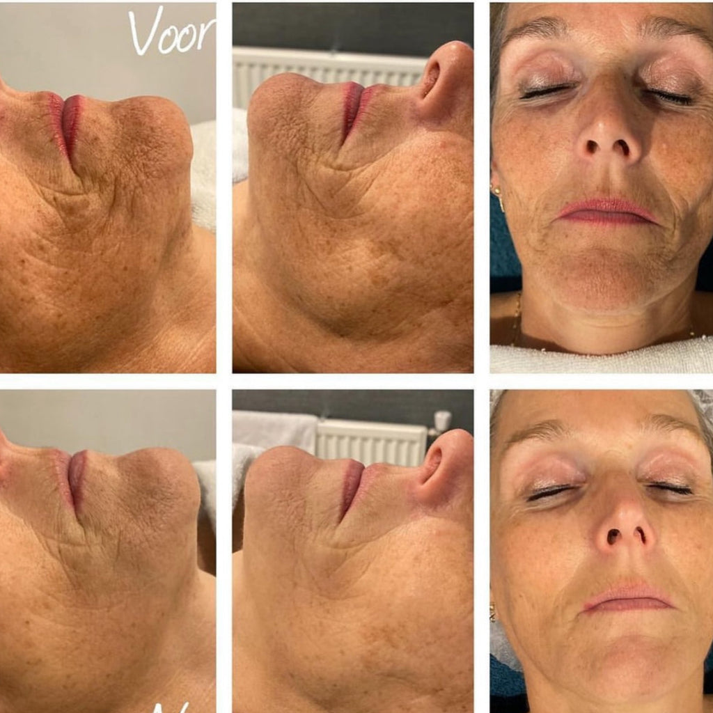 KRX Thread-Fill Ampoule - Lifting Facial Sin Agujas
