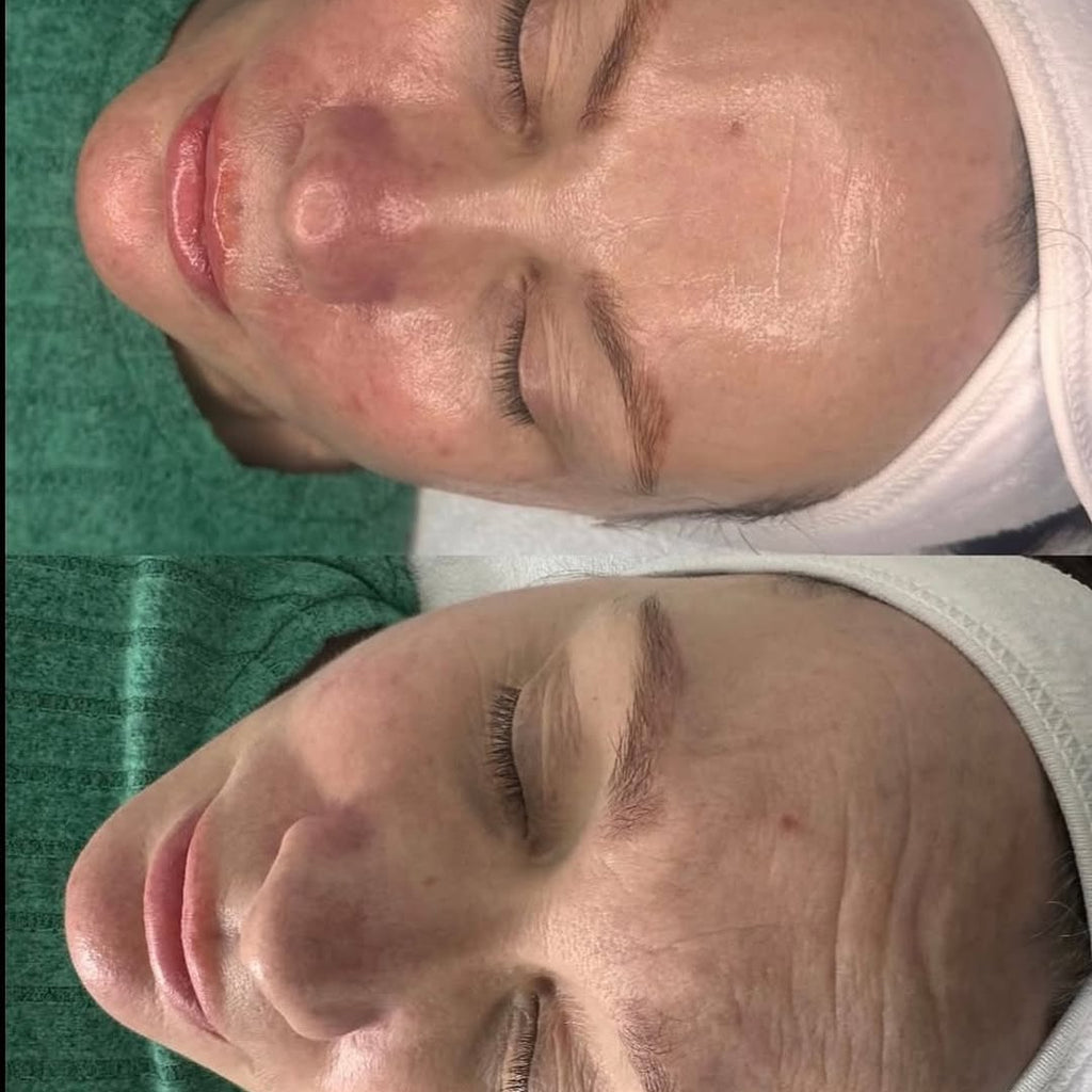 Botox Skin Booster  / Prolonga efecto del Botox