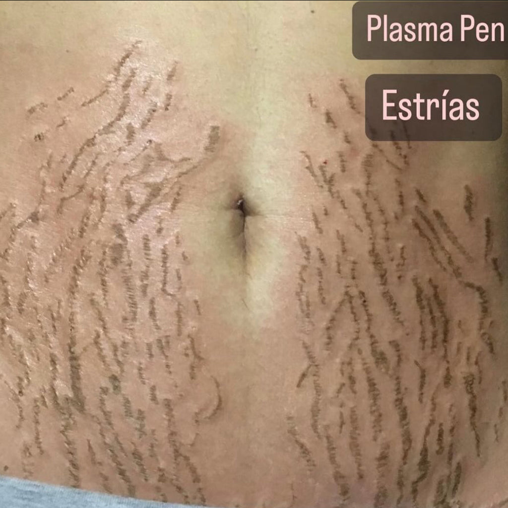 Tratamiento Anti-Cicatrices