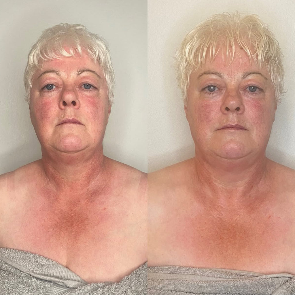 Kobido Facelift Japones Terapia facial