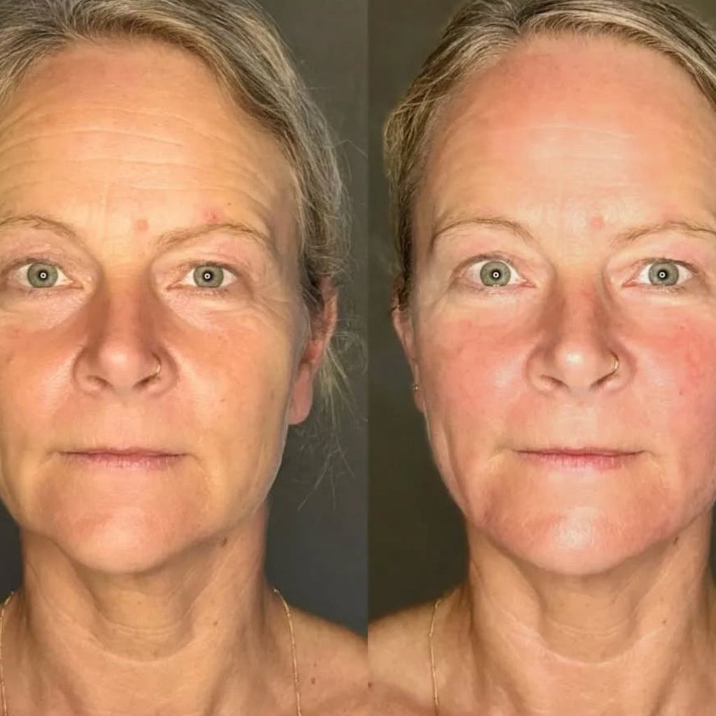 Kobido Facelift Japones Terapia facial
