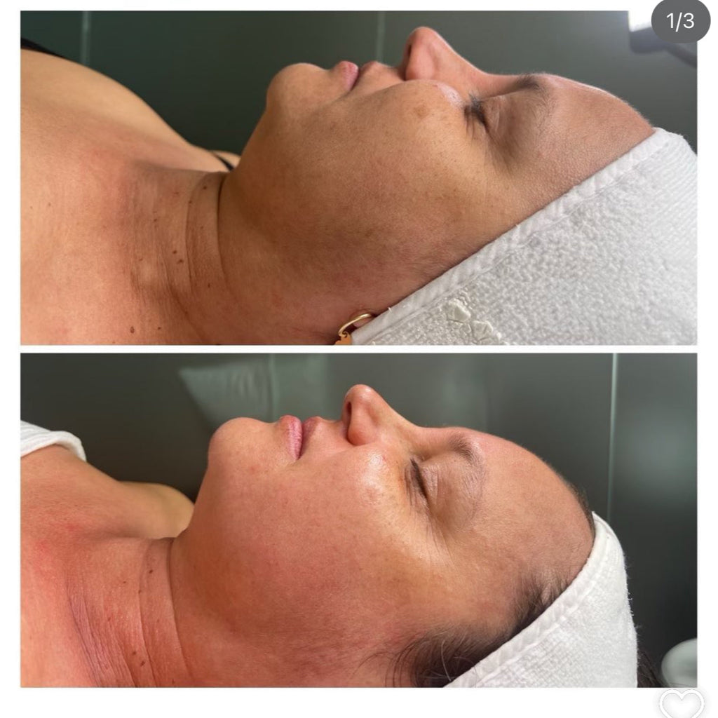 Kobido Facelift Japones Terapia facial