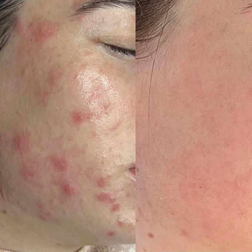 KRX PD-13 Acné y Rosacea Therapy