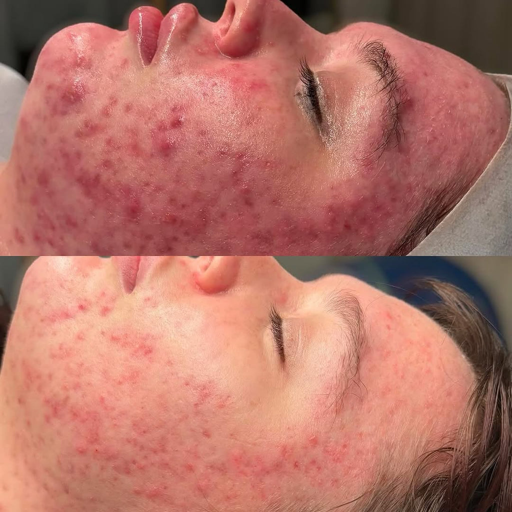KRX PD-13 Acné y Rosacea Therapy