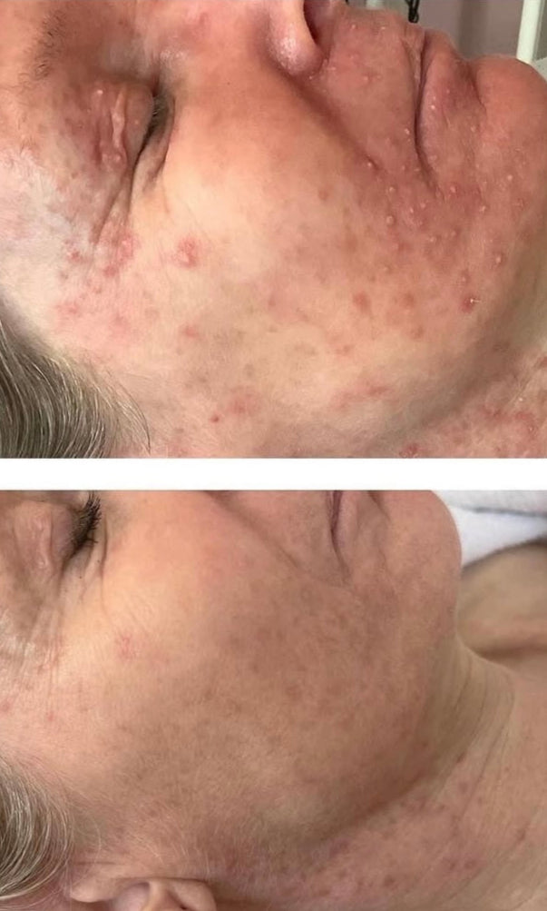 KRX PD-13 Acné y Rosacea Therapy