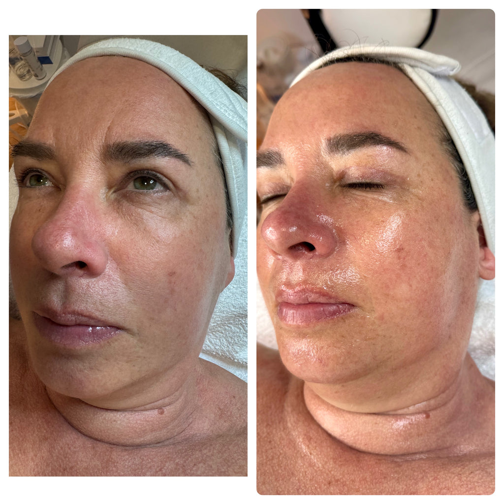 Peeling Quimico