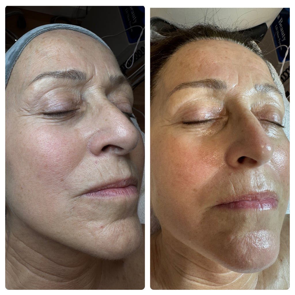 Peeling Quimico