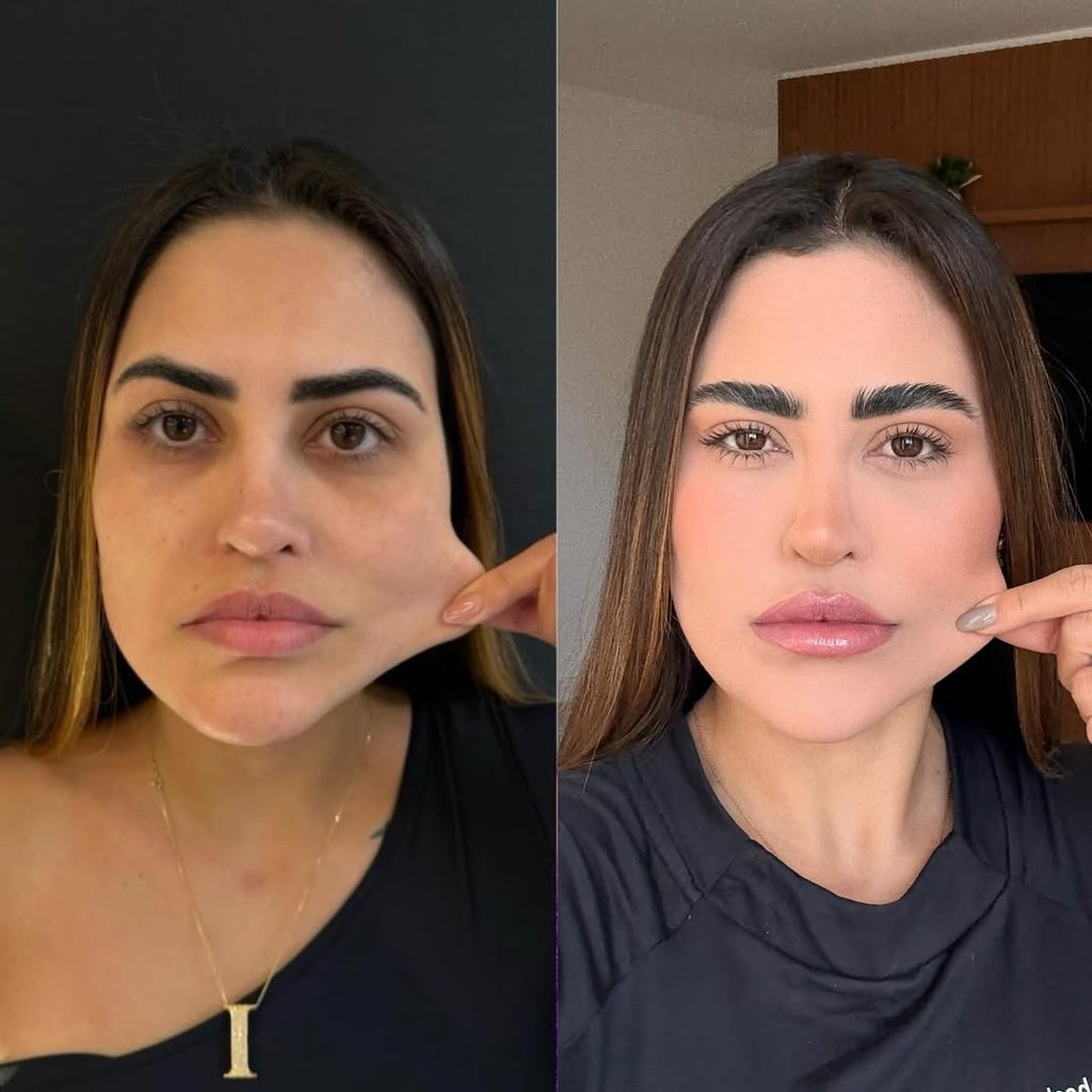 Rejuvenecimiento facial con Dust Galaxy – Bioestimulador con ácido poliláctico