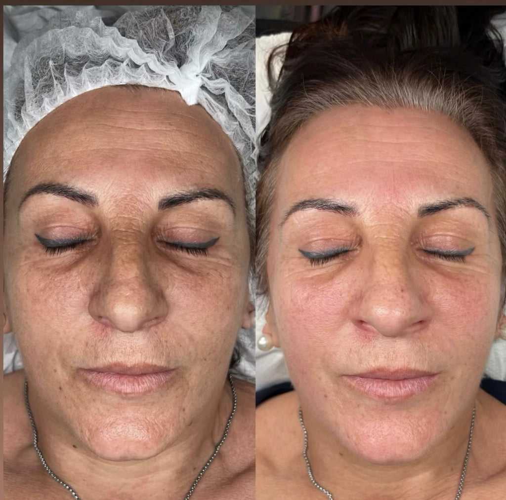 Rejuvenecimiento facial con Dust Galaxy – Bioestimulador con ácido poliláctico