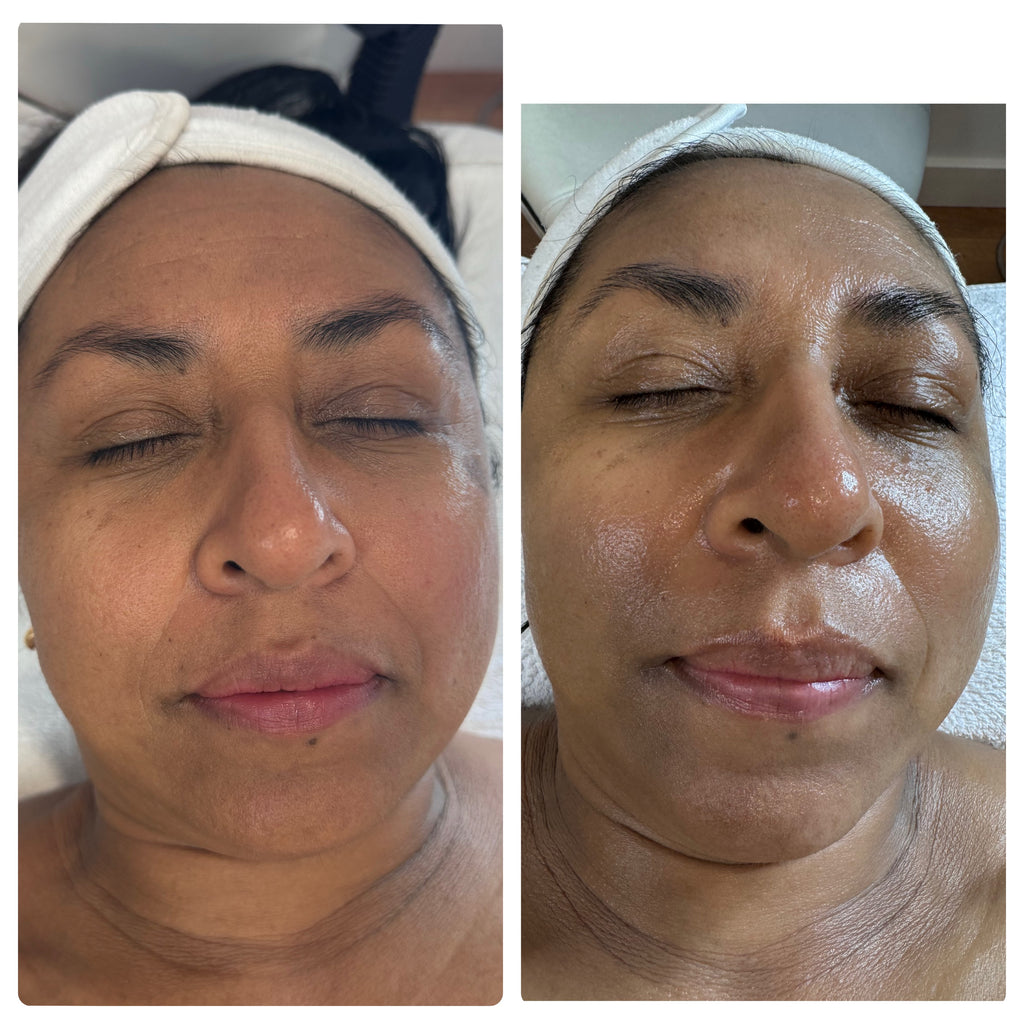 Peeling Quimico