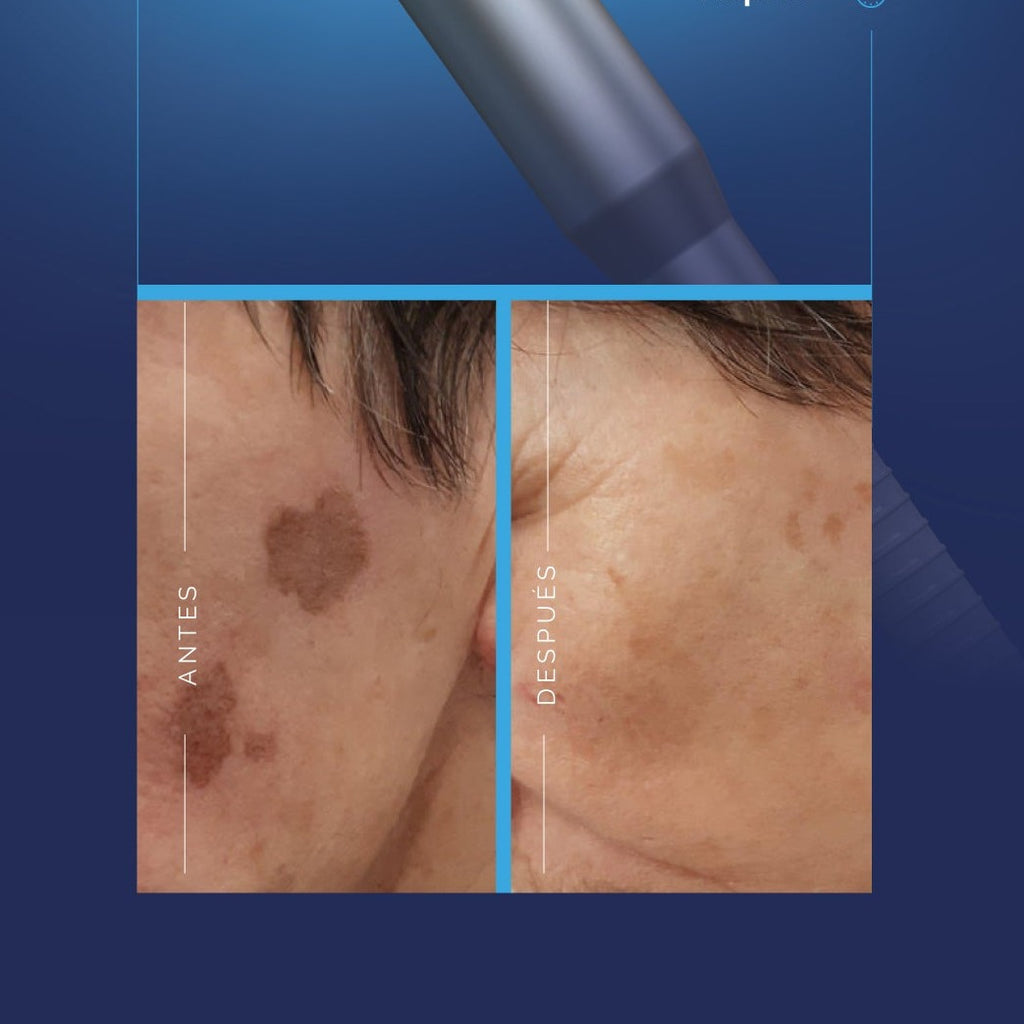 Laser Azul para lesiones benignas y manchas