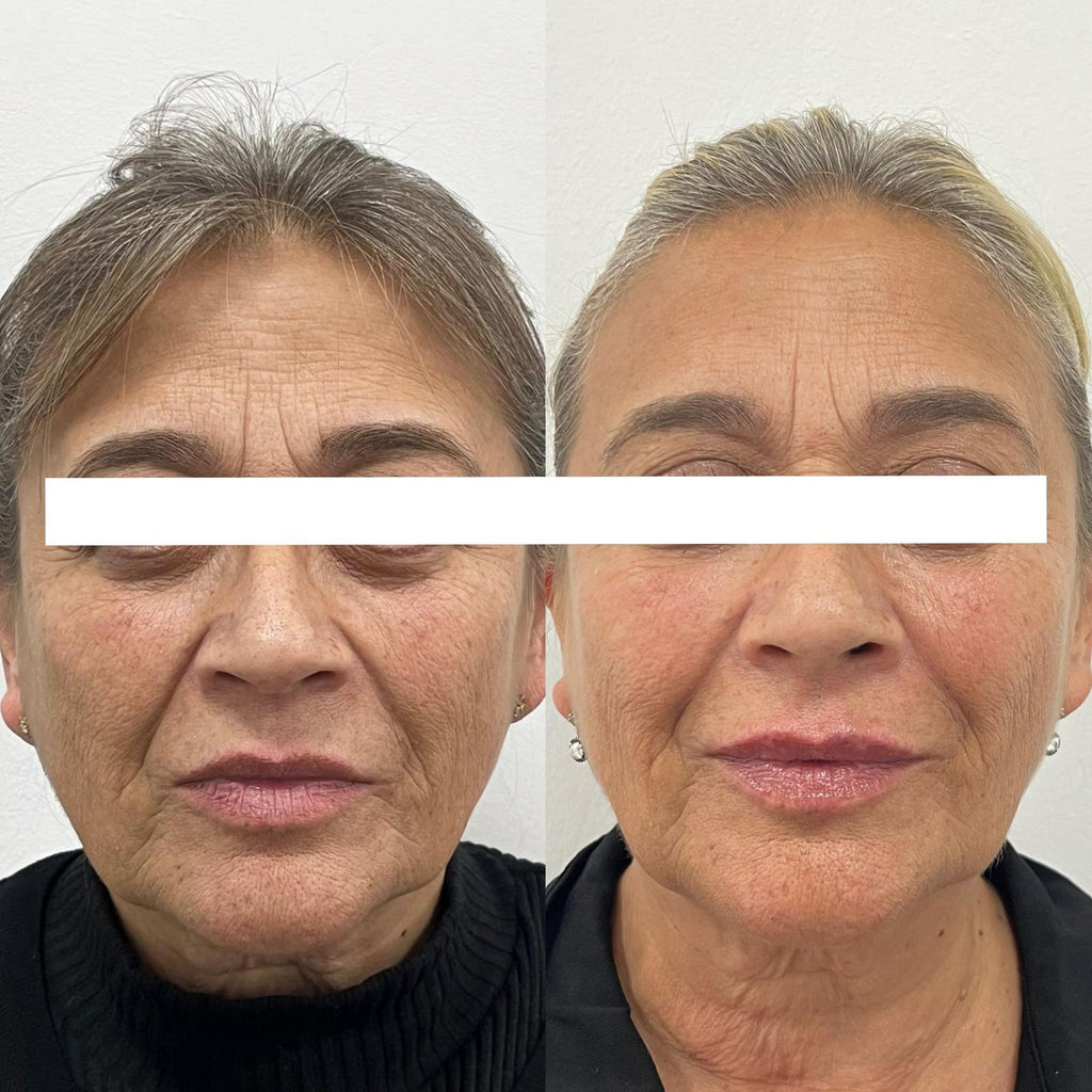 Rejuvenecimiento facial con Dust Galaxy – Bioestimulador con ácido poliláctico