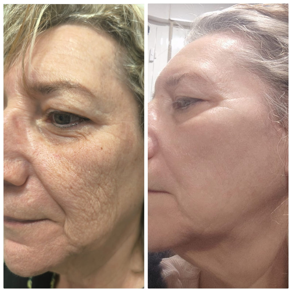 Tratamiento Anti-Arrugas