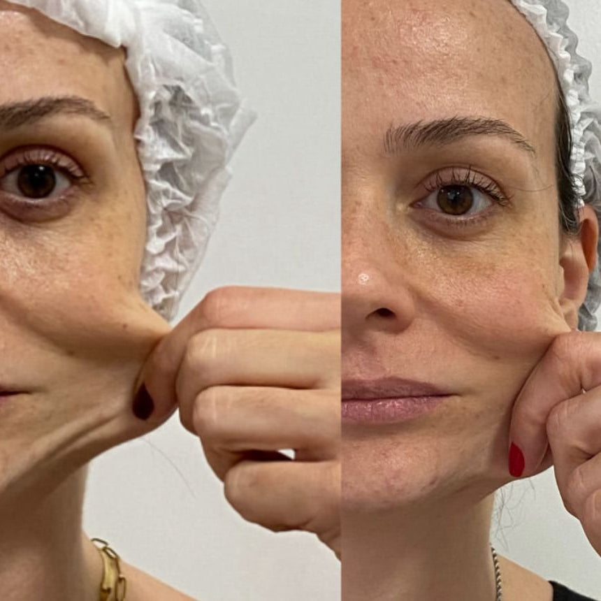 Rejuvenecimiento facial con Dust Galaxy – Bioestimulador con ácido poliláctico